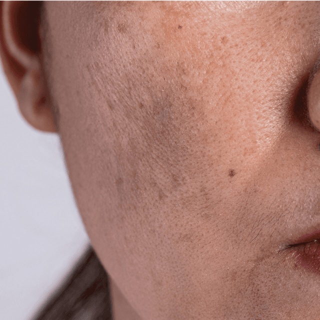 Pigmentation Correction Peel Series at LUNA Beauty Lounge in Destin, FL